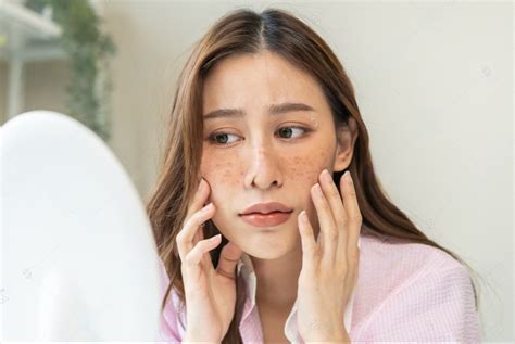 5 Tips Ampuh Hilangkan Melasma di Wajah dalam 2 Minggu!