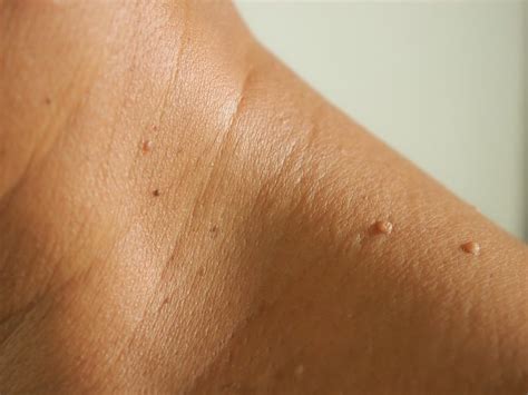 7 Cara Natural Menghilangkan Skin Tags di Rumah  😉