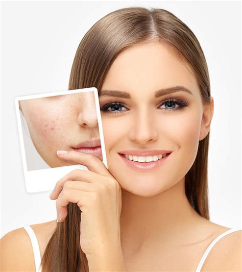 7 Cara Menghemat Harga Perawatan Wajah Jerawat Hingga 50%! 7 Cara Menghemat Harga Perawatan Wajah Jerawat Hingga 50%!