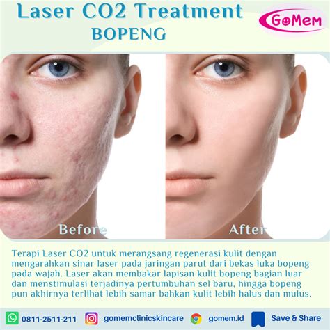 7 Cara Menghilangkan Bekas Bopeng dengan Perawatan Laser Wajah, Harga Mulai Rp 500.000!