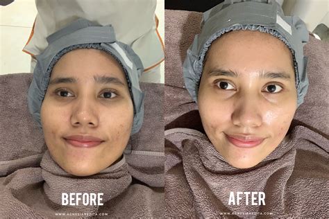 7 Fakta Mengejutkan Harga Perawatan di Erha Clinic: Mulai 99 Ribu! 7 Fakta Mengejutkan Harga Perawatan di Erha Clinic: Mulai 99 Ribu!