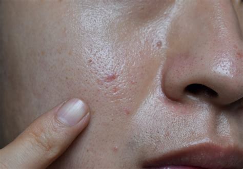 7 Rahasia Ampuh Basmi Jerawat: Kulit Mulus dalam Seminggu! 7 Rahasia Ampuh Basmi Jerawat: Kulit Mulus dalam Seminggu!