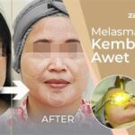 ✨5 Rekomendasi Laser Kecantikan Efek Jitu Ngilangin Flek Hitam Warga Dekat!✨