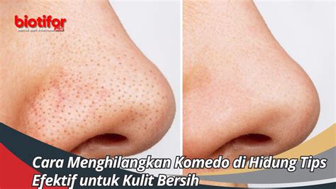 5 Bahan Alami Ampuh Hilangkan Komedo, Bikin Wajah Cerah! 5 Bahan Alami Ampuh Hilangkan Komedo, Bikin Wajah Cerah!