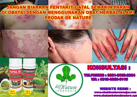 5 Hal Ajaib untuk Hilangkan Eksim dalam 7 Hari! 5 Hal Ajaib untuk Hilangkan Eksim dalam 7 Hari!