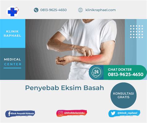 5 Hal Ajaib untuk Hilangkan Eksim dalam 7 Hari! 5 Hal Ajaib untuk Hilangkan Eksim dalam 7 Hari!