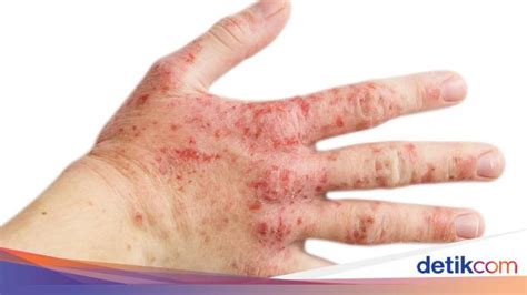5 Hal Ajaib untuk Hilangkan Eksim dalam 7 Hari! 5 Hal Ajaib untuk Hilangkan Eksim dalam 7 Hari!