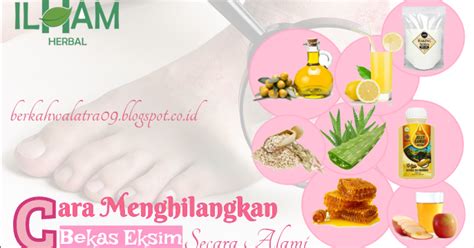 5 Hal Ajaib untuk Hilangkan Eksim dalam 7 Hari! 5 Hal Ajaib untuk Hilangkan Eksim dalam 7 Hari!