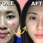 5 Tips Ampuh Atasi Jerawat Meradang Dalam Semalam!