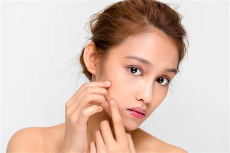 5 Tips Ampuh Atasi Jerawat Meradang Dalam Semalam! 5 Tips Ampuh Atasi Jerawat Meradang Dalam Semalam!