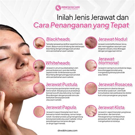5 Tips Ampuh Atasi Jerawat Meradang Dalam Semalam! 5 Tips Ampuh Atasi Jerawat Meradang Dalam Semalam!