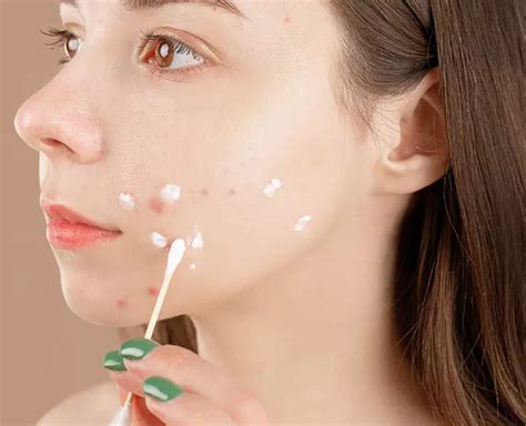 5 Tips Ampuh Atasi Jerawat Meradang Dalam Semalam! 5 Tips Ampuh Atasi Jerawat Meradang Dalam Semalam!