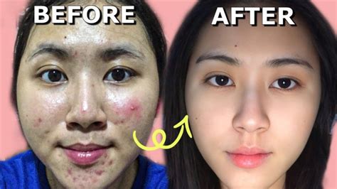 5 Tips Ampuh Atasi Jerawat Meradang Dalam Semalam! 5 Tips Ampuh Atasi Jerawat Meradang Dalam Semalam!