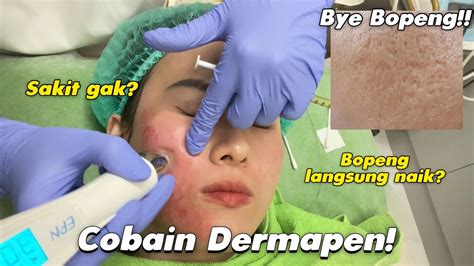 7 Perawatan Bopeng Dermaster Terbaik: Bye-Bye Kulit Tak Rata! 7 Perawatan Bopeng Dermaster Terbaik: Bye-Bye Kulit Tak Rata!