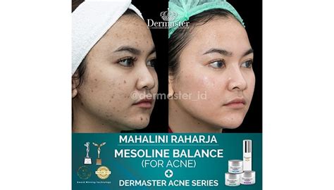 7 Perawatan Bopeng Dermaster Terbaik: Bye-Bye Kulit Tak Rata! 7 Perawatan Bopeng Dermaster Terbaik: Bye-Bye Kulit Tak Rata!