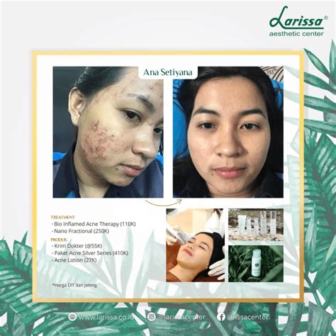 7 Perawatan Wajib di Larissa untuk Kulit Glowing Alami! 7 Perawatan Wajib di Larissa untuk Kulit Glowing Alami!