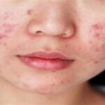 7 Rahasia Wajah Mulus Bebas Jerawat dengan Bahan Alami!