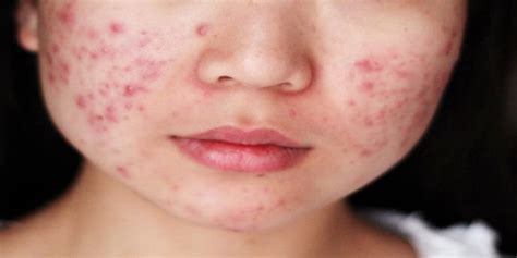 7 Rahasia Wajah Mulus Bebas Jerawat dengan Bahan Alami! 7 Rahasia Wajah Mulus Bebas Jerawat dengan Bahan Alami!