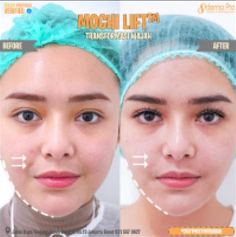 Rahasia Mochi Skin Terungkap! Harga Dermapro Terbaru 2024 (Versi 7 Langkah)! Rahasia Mochi Skin Terungkap! Harga Dermapro Terbaru 2024 (Versi 7 Langkah)!